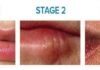 cold sore stages pictures