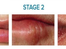 cold sore stages pictures
