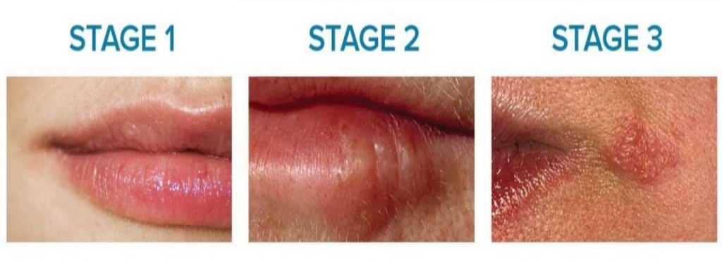 cold-sore-stages-pictures-know-how-to-get-rid-of-cold-sore