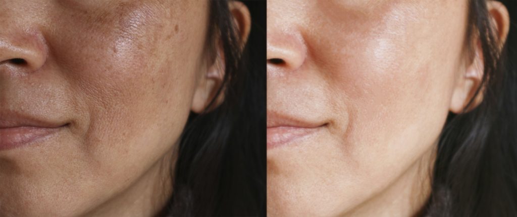 how to cure melasma from the inside