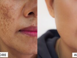 how to cure melasma from the inside